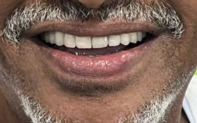 After Smile Transformation — Full Aesthetic Smile Restoration
