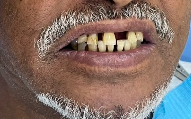 Before Smile Transformation — Dental Wear and Spacing