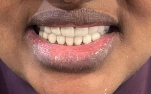 After Patient Transformation — Restored Smile with Dental Implants