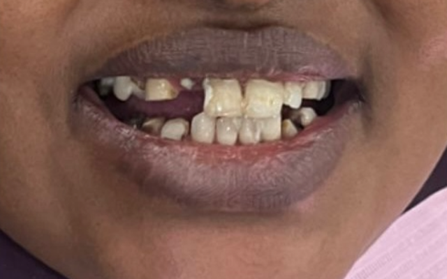 Before Patient Transformation — Anterior Gaps and Missing Teeth