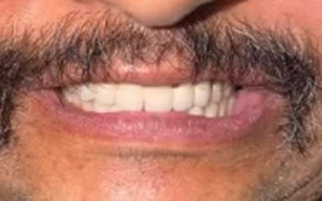 After Smile Makeover — Restored Radiant Smile with Porcelain Aesthetics