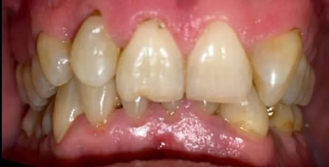 Before Teeth Whitening — Dental Staining and Wear