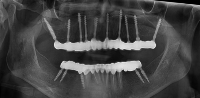 After Full Mouth Rehabilitation — Full-Arch Implant Reconstruction Radiograph