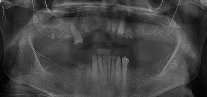 Before Full Mouth Rehabilitation — Pre-Operative Radiograph