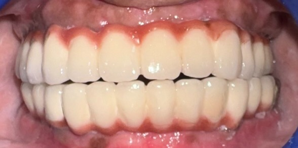 After Alignment Correction — Frontal Balanced Aesthetic Occlusion