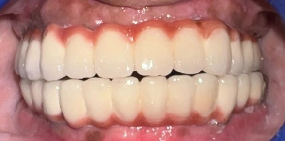 After Alignment Correction — Frontal Balanced Aesthetic Occlusion